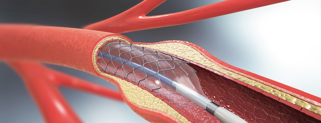 ANGIOPLASTY TREATMENT SPECIALIST